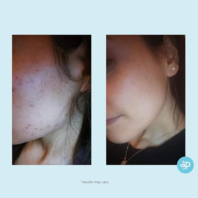 Salicylic 10% Gel Peel, Breakout and Pore Minimizer and Cleanser, 15-30 Full Facial Chemical Peels, 1 fl oz. e, 30 mL – Perfect Image